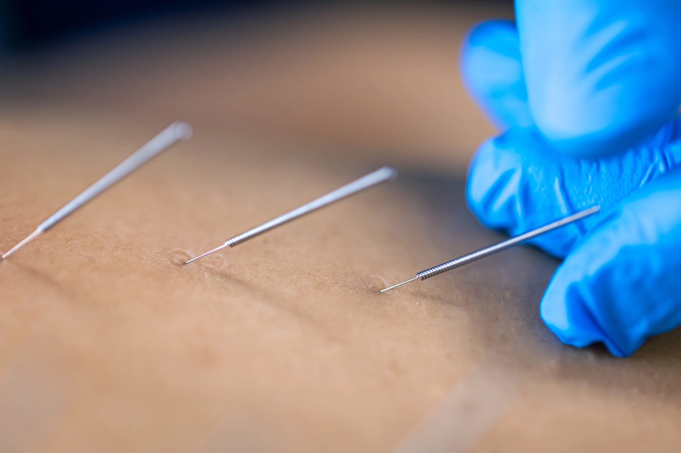 Trattamento di dry needling